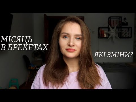 Видео: БРЕКЕТИ | ПЕРШИЙ МІСЯЦЬ | ЗНЕБОЛЮЮЧЕ | ДОГЛЯД | БОЛІ | РОЗПИРАННЯ | ХОЧУ ЗНЯТИ | РУХЛИВІСТЬ ЗУБІВ