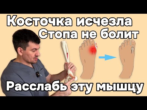Видео: Косточка на большом пальце стопы исчезает навсегда. Нужно расслабить эту мышцу. Причина в ней