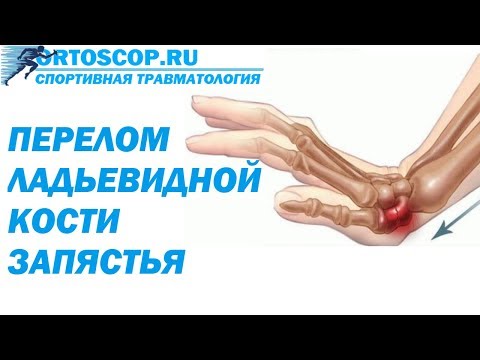 Видео: ПЕРЕЛОМ ЛАДЬЕВИДНОЙ КОСТИ ЗАПЯСТЬЯ