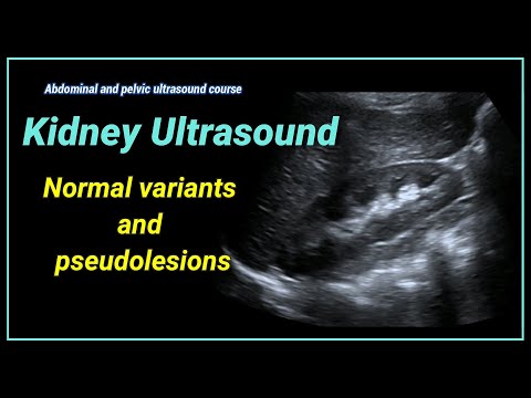 Видео: УЗИ почек 2- Варианты нормы и псевдопоражения