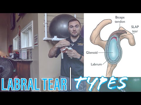 Видео: Разрыв суставной губы | Типы и прогноз разрыва суставной губы