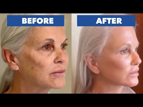 Видео: Потрясающие результаты подтяжки лица «Омакасэ» для 65-летней женщины