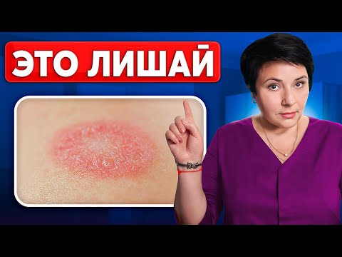 Видео: Как избавиться от лишая на коже? Пошаговая инструкция