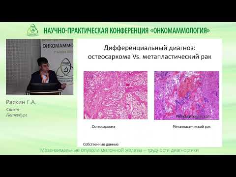 Видео: Мезенхимальные опухоли молочной железы