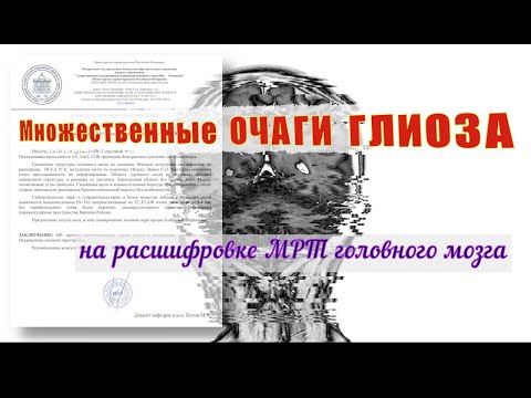 Видео: Множественные ОЧАГИ ГЛИОЗА в белом веществе лобных и теменных долей на расшифровке МРТ мозга