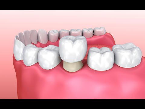Видео: Восстановление зуба: пломба или коронка