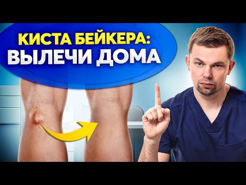 Видео: Главные ПРАВИЛА лечения боли под коленом. Избавься от кисты Бейкера НАВСЕГДА!