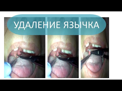 Видео: Частичное удаление язычка резекция нёбного язычка бескровная радиоволновая ЛОР хирургия от храпа
