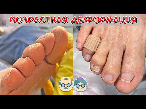 Видео: Уход за ногтями на ногах / Обработка ногтей фрезой