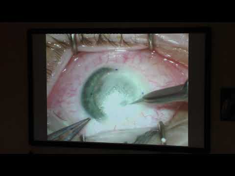 Видео: Глубокая передняя послойная кератопластика