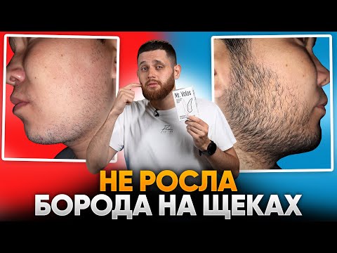Видео: За 3 месяца зарастил щёки с помощью mr.Volos / Результаты подписчиков