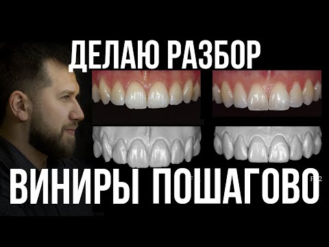 Видео: Макет зубов. Препарирование под Виниры для идеальной улыбки