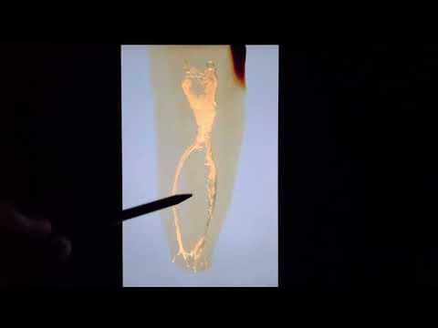 Видео: Нельзя депульпировать зуб под коронку! Киста зуба Периодонтит Лечение кисты зуба Удаление кисты зуба