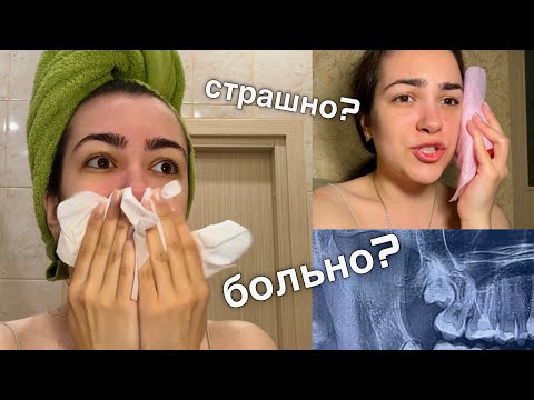 Видео: УДАЛИЛА СЛОЖНЫЙ ЗУБ МУДРОСТИ 🦷 влог
