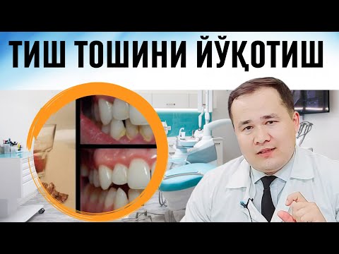 Видео: ТИШ ТОШИНИ ВА САРИҒИНИ УЙ ШАРОИТИДА ЙЎҚОТИШНИ ТАБИИЙ УСУЛИ