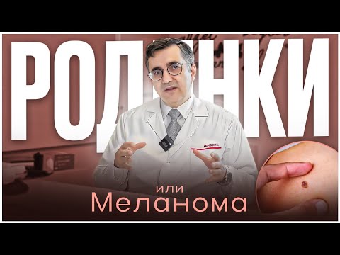 Видео: Родинки или меланома? Как разобраться и не пропустить рак