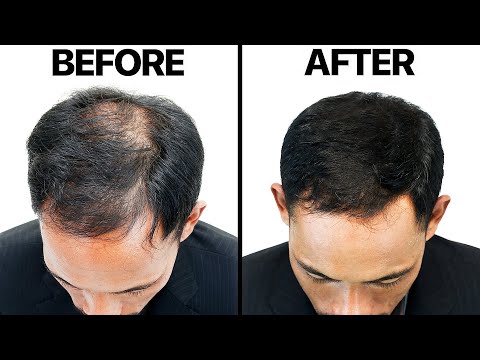 Видео: Финастерид (Пропеция) от выпадения волос