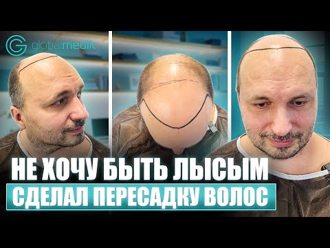Видео: Пересадка волос в Турции |  Все о двухэтапной пересадке волос FUE и DHI
