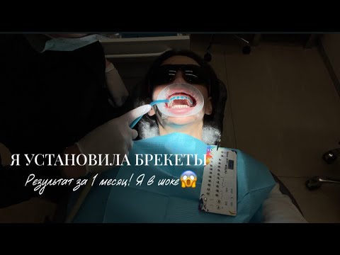 Видео: УСТАНОВИЛА БРЕКЕТЫ: результат через месяц😱, уход за зубами, лайфхаки
