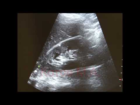 Видео: Методика УЗИ почек