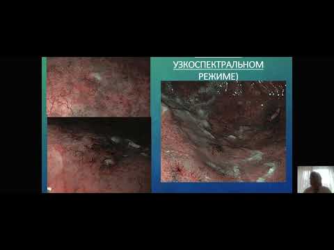 Видео: Первичные Неходжкинские лимфомы ЖКТ