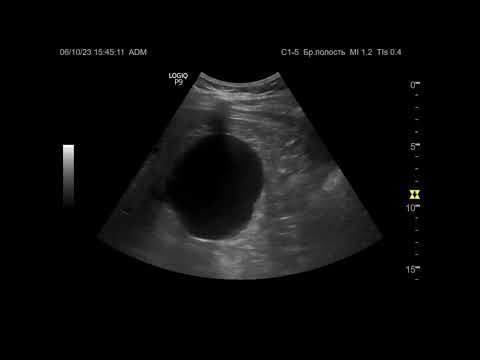Видео: Ультразвуковая диагностика (УЗИ). Доктор Иогансен. Видеопримеры. Выпуск 45. Кисты почек (2).