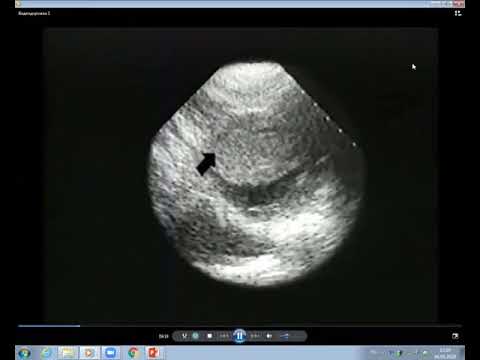 Видео: Видеолекция клиники Мэйо  Кардиомиопатии 7 я лекция