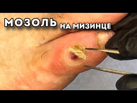 Видео: Удаление болезненной сухой мозоли на мизинце