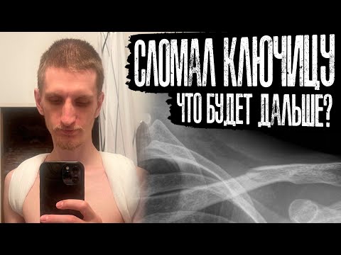 Видео: Как я сломал ключицу на велосипеде и что будет дальше