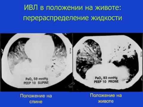 Видео: Респираторная поддержка при ОРДС (кИВЛ14дек) Киров М. Ю.