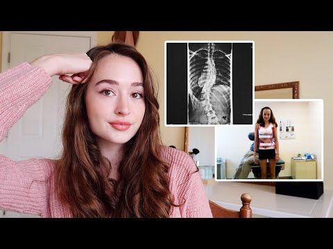 Видео: Мой путь с тяжёлым сколиозом | Вопросы и ответы