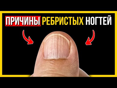 Видео: О чём кричат ВЕРТИКАЛЬНЫЕ БОРОЗДЫ на ногтях? Не лечите симптом, ищите ПРИЧИНУ✅