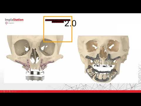 Видео: Вебинар "Компьютерное планирование имплантации: легкий старт с ImplaStation" 2021