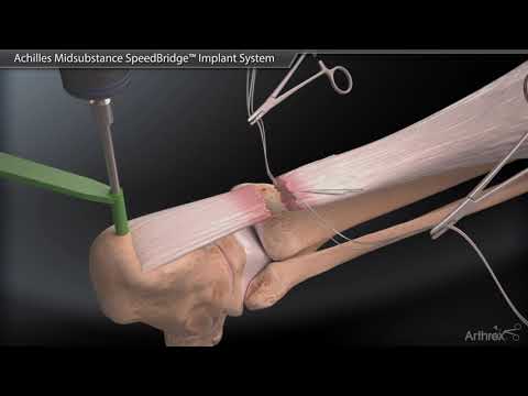 Видео: Система имплантатов Achilles Midsubstance SpeedBridge™