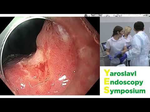 Видео: Эндоскопическая диссекция раннего рака желудка. Тору Ито