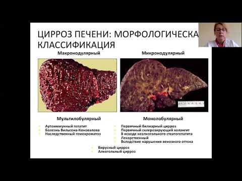 Видео: Цирроз печени и его осложнения