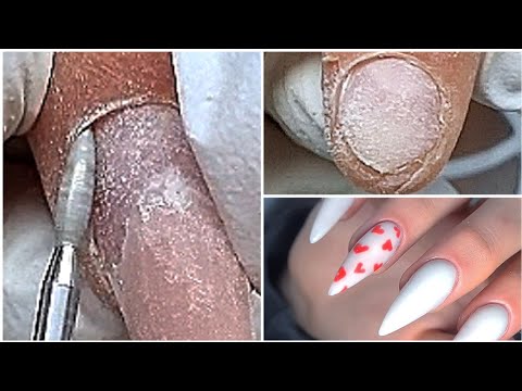 Видео: ЯМКИ от отслоек