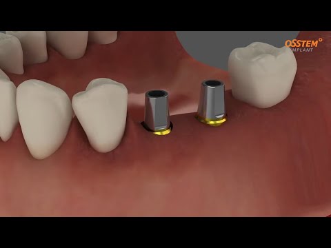 Видео: Transfer Abatment.  Установка имплантата и снятие слепка