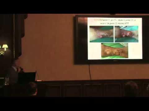 Видео: Регионарная перфузия при транзиторных метастазах на конечностях