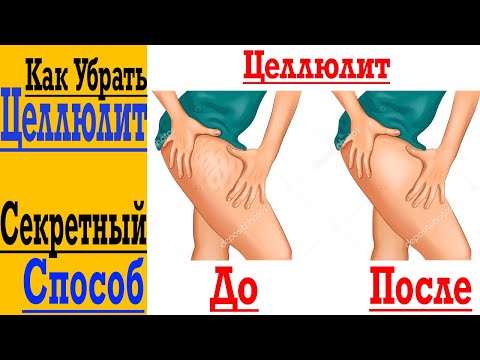 Видео: Как ИЗБАВИТЬСЯ от ЦЕЛЛЮЛИТА !? Проверенный и Простой Способ !