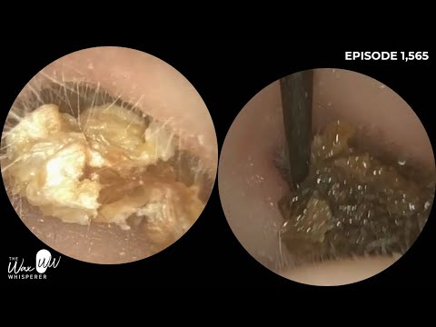 Видео: 1565 — У пациента, страдающего от наружного отита, удалены омертвевшие кожные пробки и отшелушена...