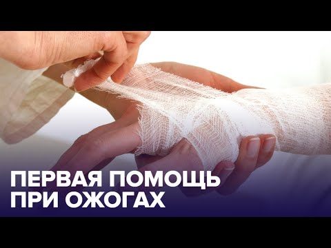 Видео: Первая помощь при ОЖОГАХ: как ее оказывать?