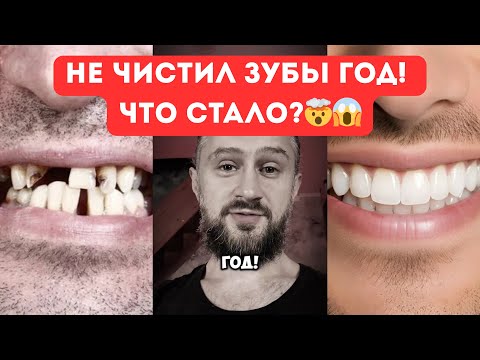 Видео: НЕ ЧИСТИЛ ЗУБЫ ГОД🤯 Что стало? #зубы #зубнаяболь #психосоматика #эксперимент #хельги #здоровье 
