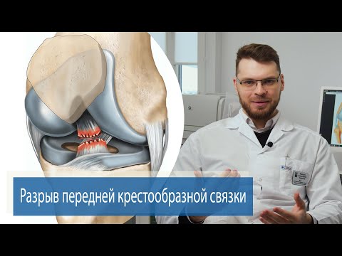 Видео: РАЗРЫВ ПЕРЕДНЕЙ КРЕСТООБРАЗНОЙ СВЯЗКИ