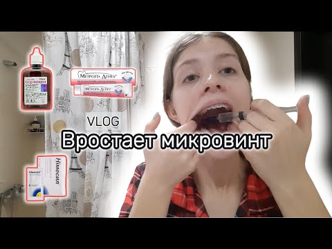 Видео: Проблемы с микроимплантом😪| Мой день | Влог✨️