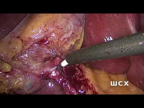 Видео: LC+CVS-Лапароскопическая холецистэктомия с критериями безопасности