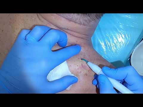 Видео: Удаление атеромы спины