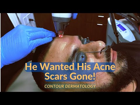 Видео: Чего ожидать от лазера Fraxel при лечении рубцов от угревой сыпи, морщин и гиперпигментации у муж...