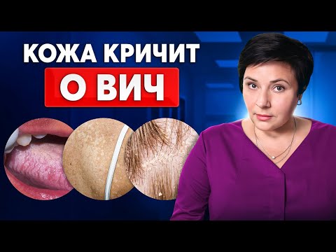 Видео: Как проявляется ВИЧ на коже? ПЕРВЫЕ ОПАСНЫЕ СИМПТОМЫ