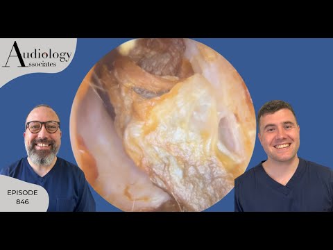 Видео: Зудящие ушные каналы. Удаление ушной серы. Фиксированное и переднее углубление. EP846